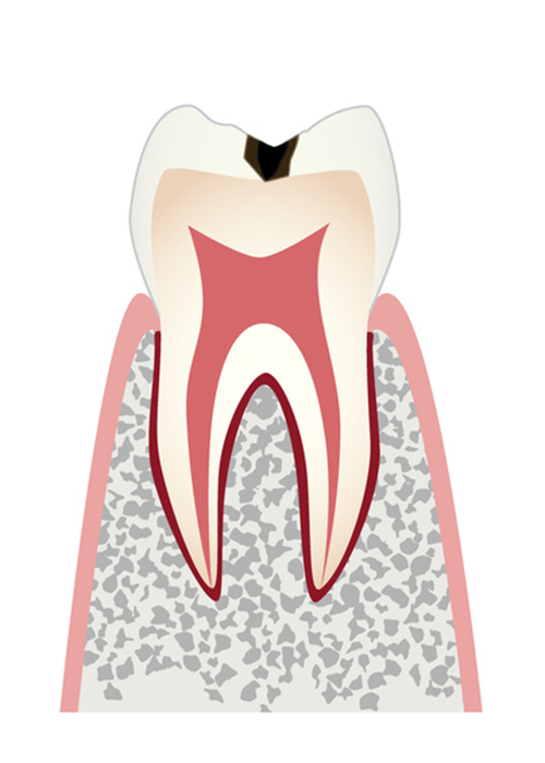 歯の表面に穴が開き始めた虫歯